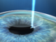 Una tecnología avanzada en cirugía ocular